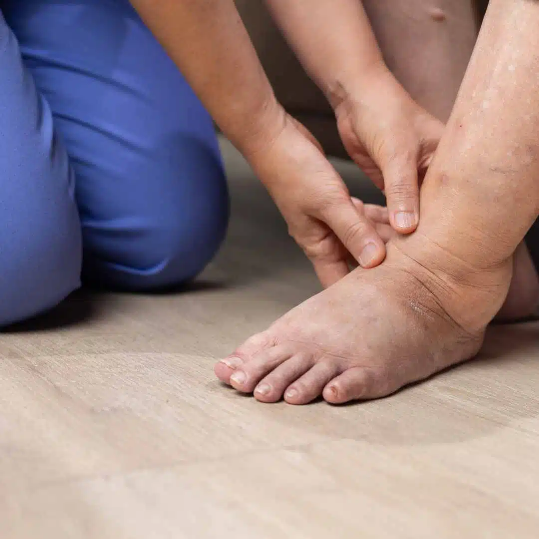 Inchaço e Edema em idosos