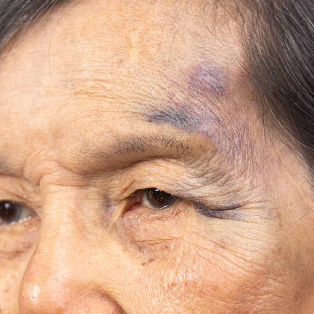 Os perigos da queda na terceira idade