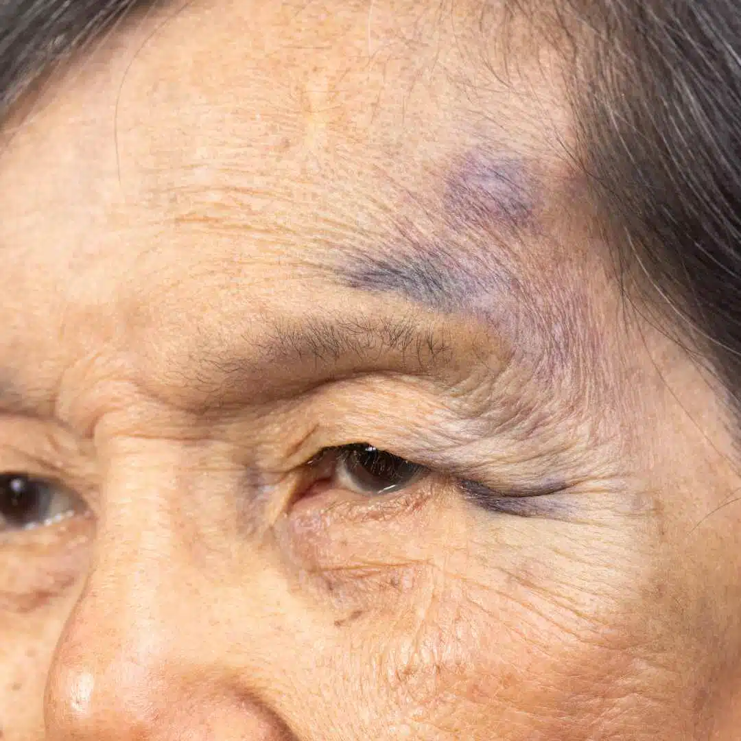 Os perigos da queda na terceira idade