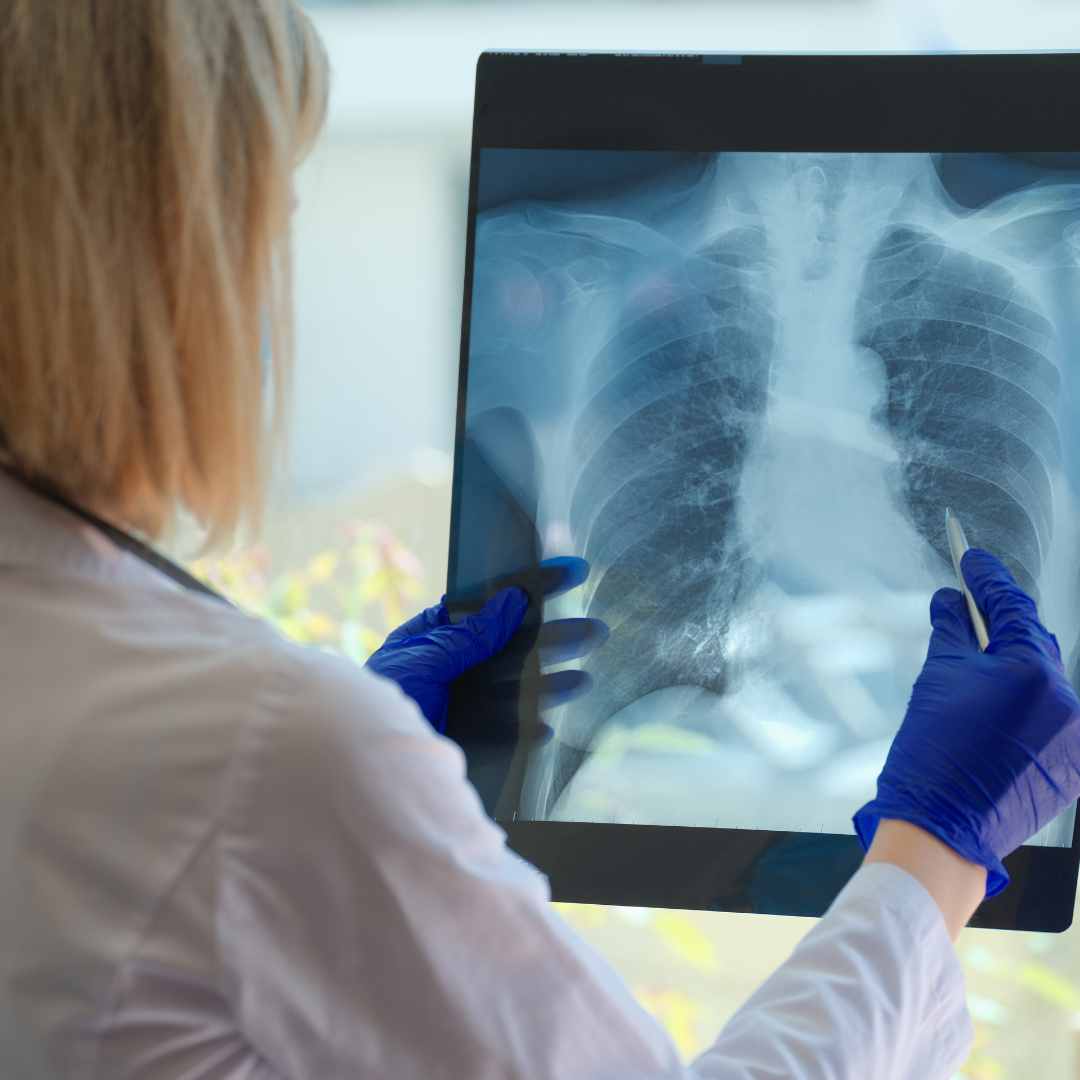 Piora na asma de idosos do DF